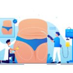 liposuction